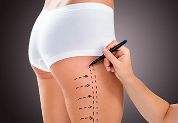 Implants-fessiers